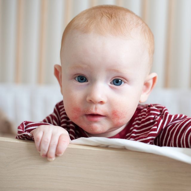 Atopický ekzém | foto: Shutterstock